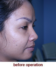 plastic_surgery_augmentation_rhinoplasty